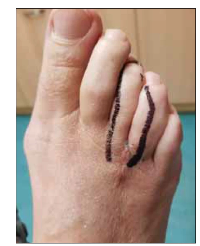 Lokalizace neuromu.<br>
Fig. 6. Location of neuroma.