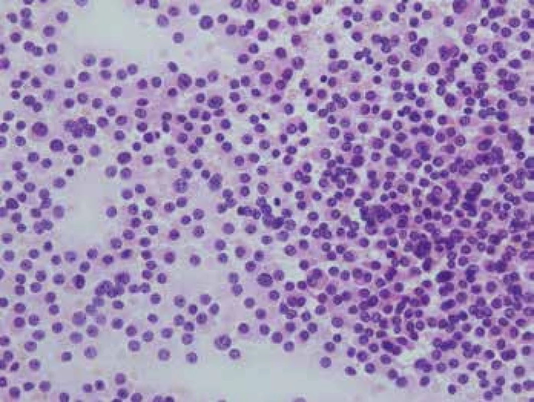 Cytologický náter adenómu hypofýzy. Homogénna populácia pomerne
rovnomerne rozptýlených „plazmocytoidných“ buniek, HE 400x.