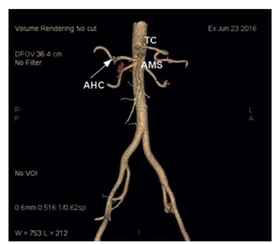 CT angiografie s 3D rekonstrukcí u pacientky s variantou
Michels IX – společná hepatická tepna odstupující
z horní mezenterické tepny<br>
Fig. 4: CT angiography with 3D reconstruction in a patient
with variant type IX according to Michels – aberrant common
hepatic artery arising from the superior mesenteric artery