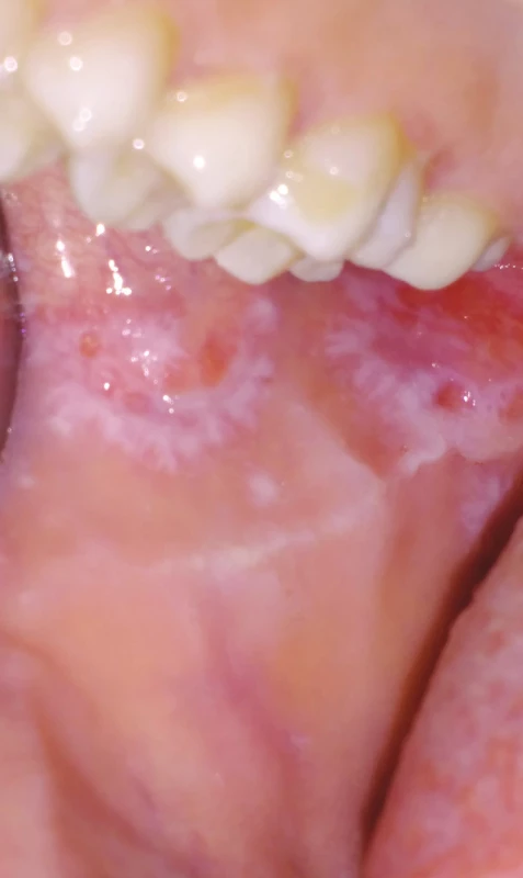 Orální lichen planus,
retikulární forma
(z archivu autorky)<br>
Fig. 6
Oral lichen planus,
reticular form
(author´s archive)