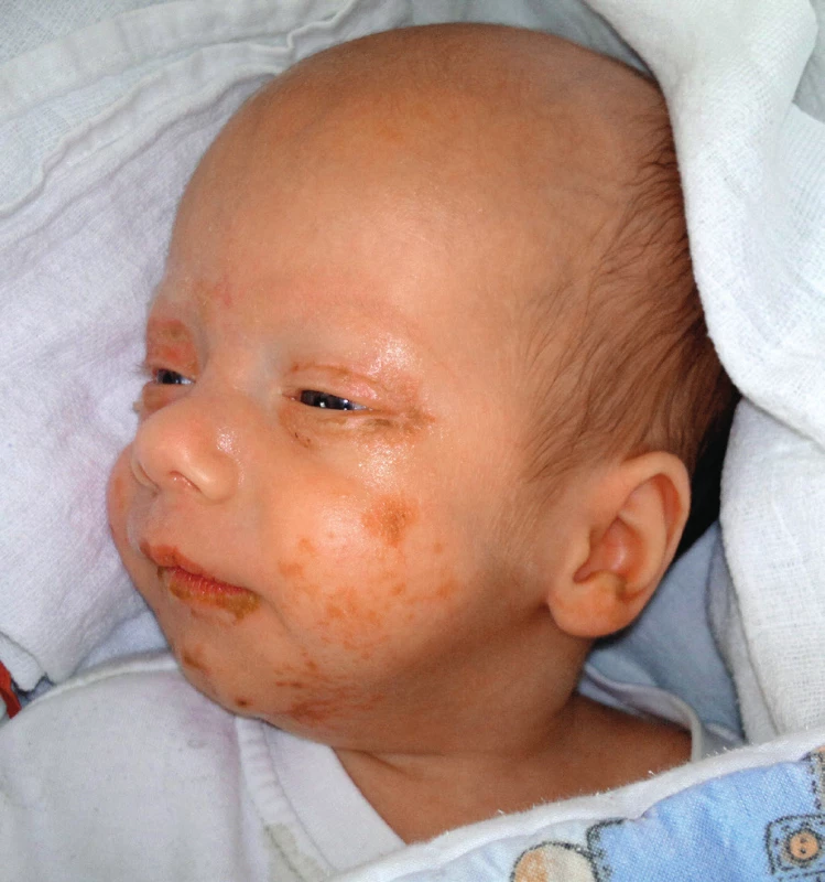 Kazuistika 1 – před zahájením suplementace zinkem.<br>
Fig. 1. Case report 1 – before zinc supplementation.