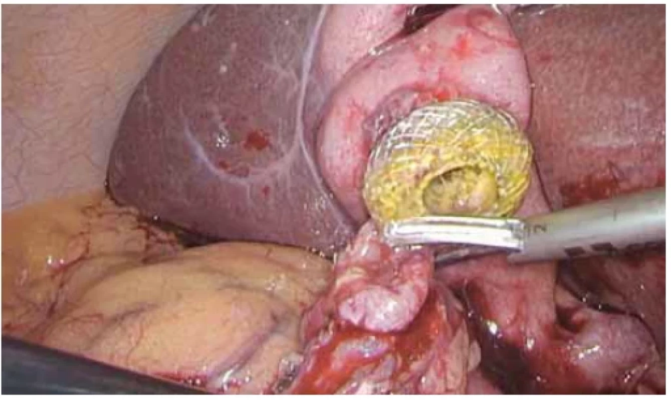 Operační nález vypreparovaného LAMS z duodena. <br> 
Fig. 12. Operative finding of LAMS extracted from the duodenum.
