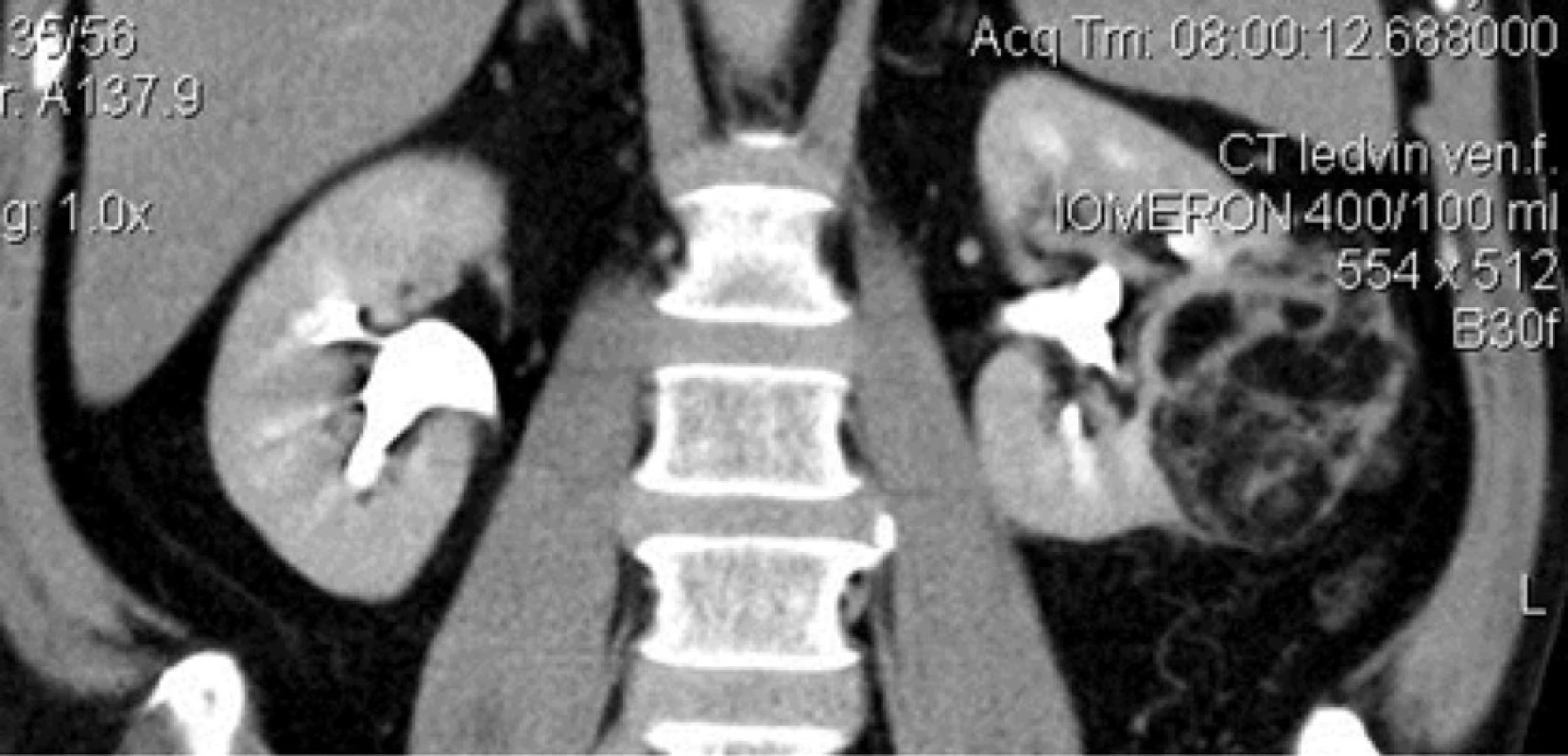Angiomyolipom levé ledviny CT (koronární řez)<br>
Fig 1. Angiomyolipoma of the left kidney CT (transverse section)