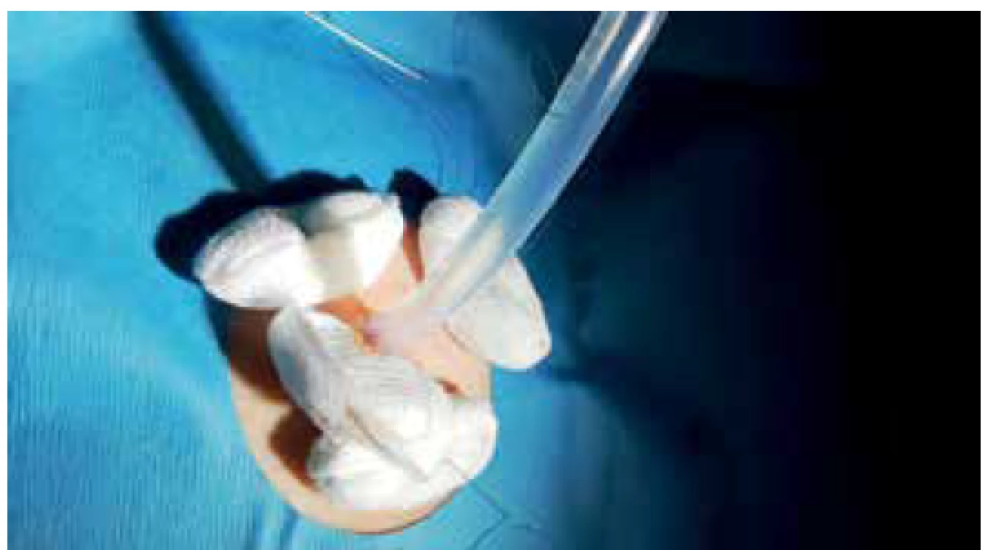 Zevní část cékostomie<br>
Fig. 5. The external part of the cecostomy