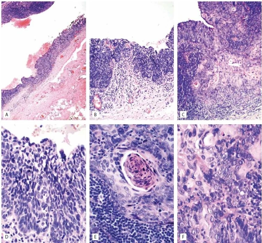 A) Branchial cleft cyst with epithelial dysplasia (40×). B) Branchial cleft cyst with high-grade epithelial dysplasia/squamous cell carcinoma <i>in situ</i> (100×). C) Invasive squamous cell carcinoma arising in the wall of branchial cleft cyst (100×). D) Epithelium with high-grade dysplasia/squamous cell carcinoma <i>in situ</i> (400×). E) Epithelium with high-grade dysplasia/squamous cell carcinoma in situ (400×). F) Nest of invasive squamous cell carcinoma, G3 (400×).