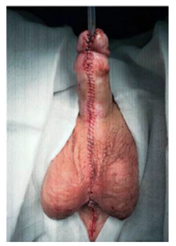 Pohled po ukončené druhé
době uretroplastiky<br>
Fig. 7. Final view after second stage
of urethroplasty