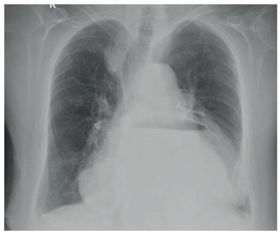 Volvulus žaludku na nativním zadopředním snímku hrudníku<br>
Fig. 1. Stomach volvulus on plain posterior-anterior chest X-ray
