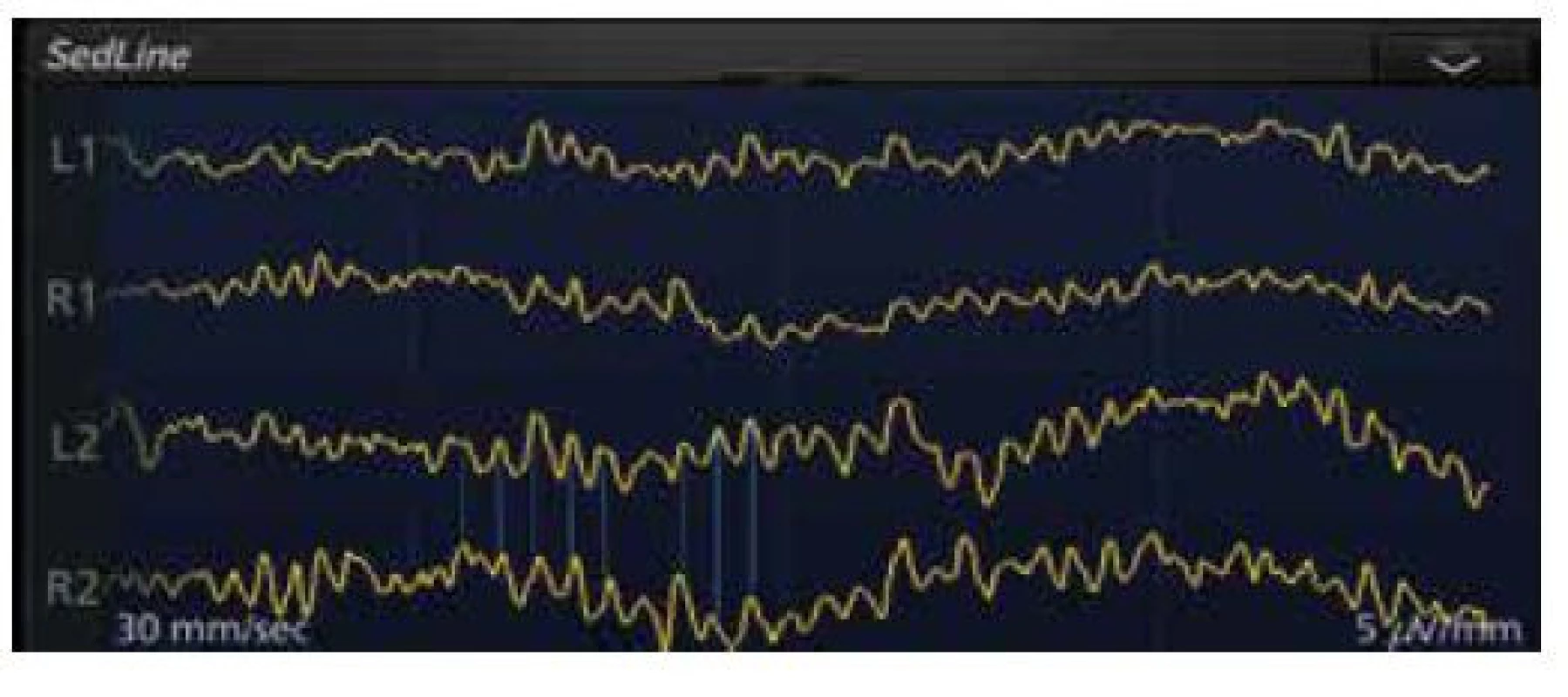 Na displeji monitoru SedLine je zdůrazněna koherence (korelace)
syrových EEG křivek snímaných z čela mezi L2 a R2 elektrodami u 69letého
pacienta s chronickou renální insuficiencí v celkové anestezii propofolem,
sevofluranem a sufentanilem k založení hemodialyzačního zkratu, Patient
State Index aktuálně 31 (doporučené rozmezí 25–50)
