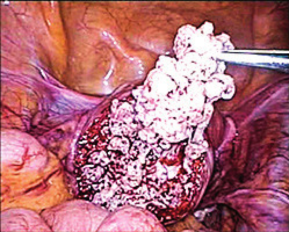 Peri-operatively suspicious tumor of uterine muscularity
(verified later as leiomyoma with bizarre nuclei) during
laparoscopic removal using endobag