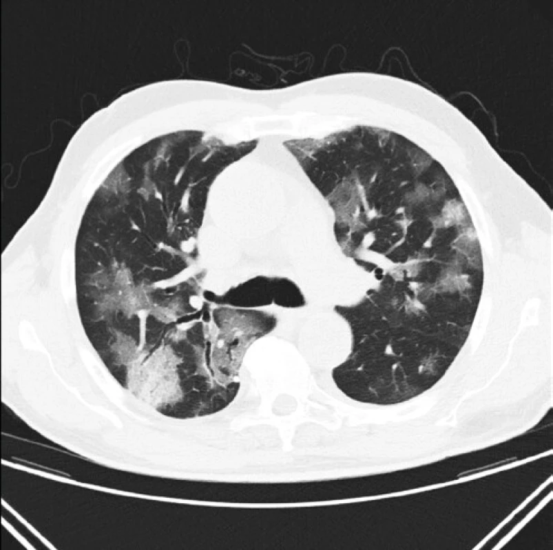 Pacient s prokázanou virovou pneumonií covid-19 a typickým nálezem multifokálních okrsků denzit mléčného skla a vpravo v S6 o obrazem 
„crazy paving“ a rozšířenými bronchy v S6