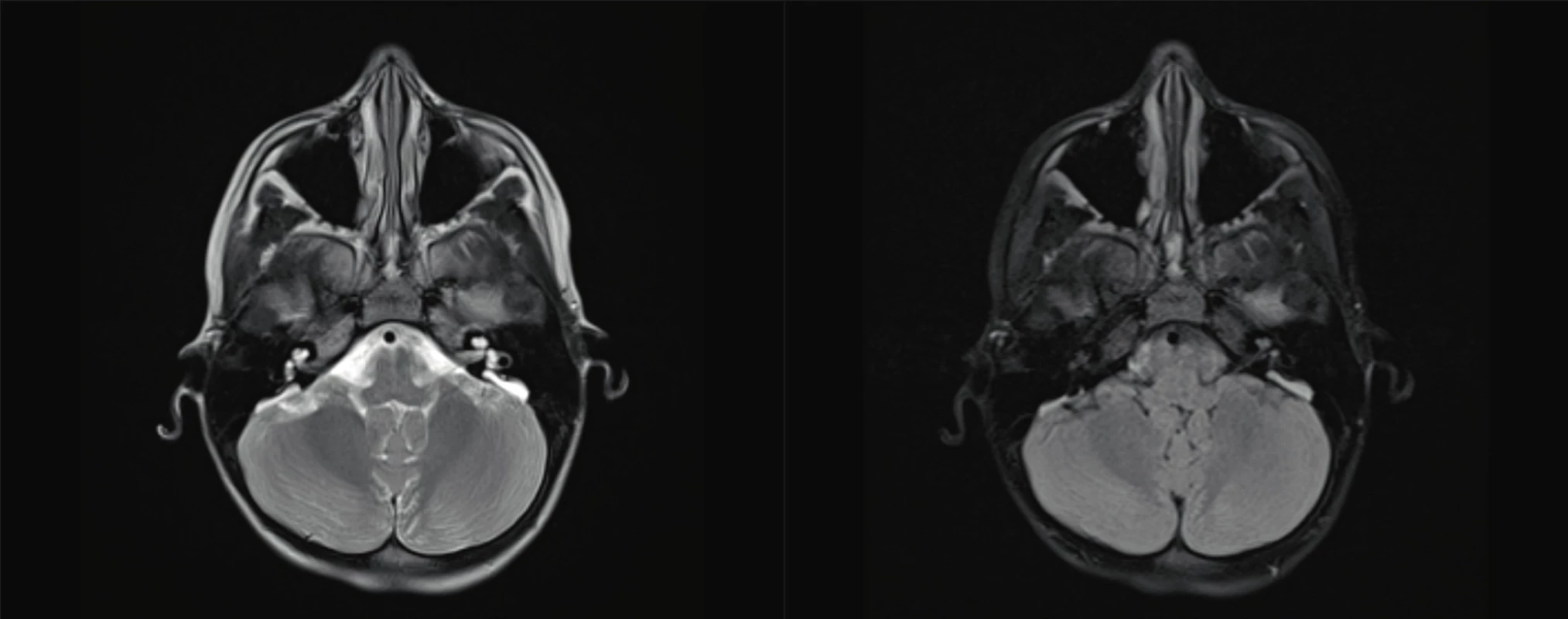 EVA syndrom, syndrom rozšířeného vestibulárního akvaduktu.<br>
Fig. 5. Enlarget vestibular aquaeduct.