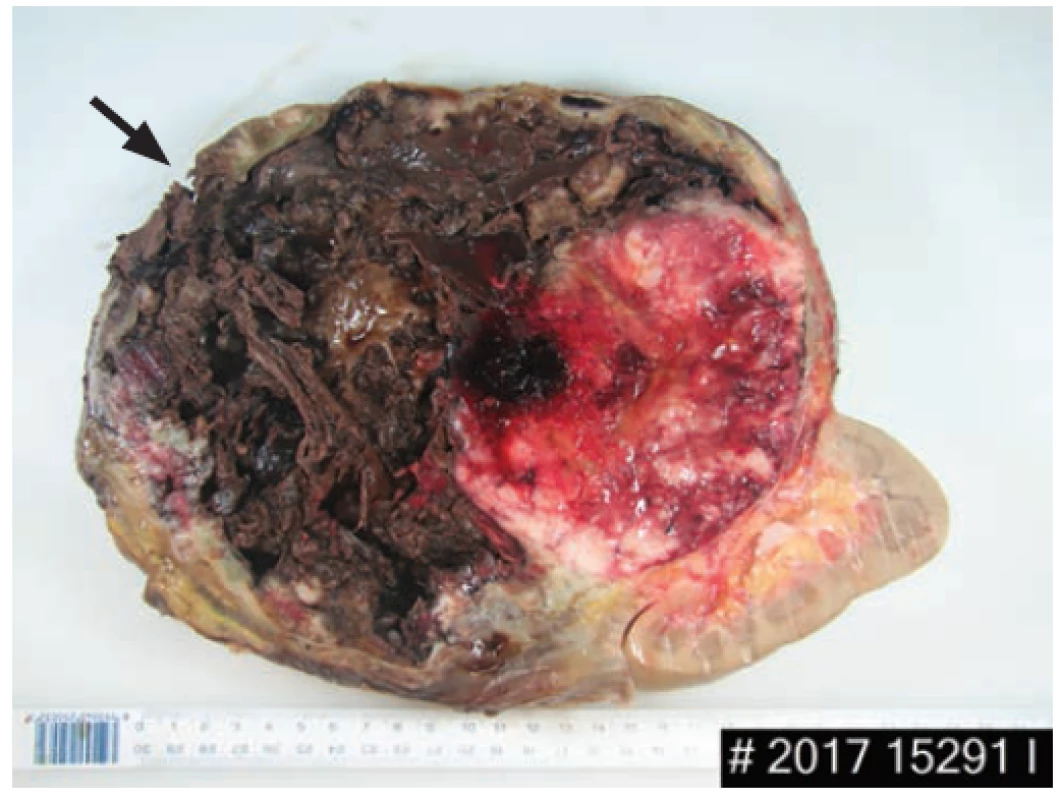 Cross section of a tumor and kidney with capsule
rupture pointed by an arrow