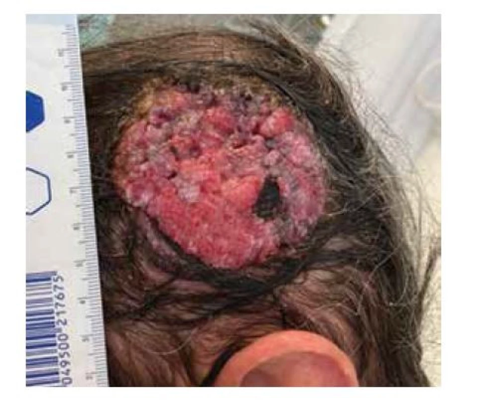 Tumor parietotemporální oblasti