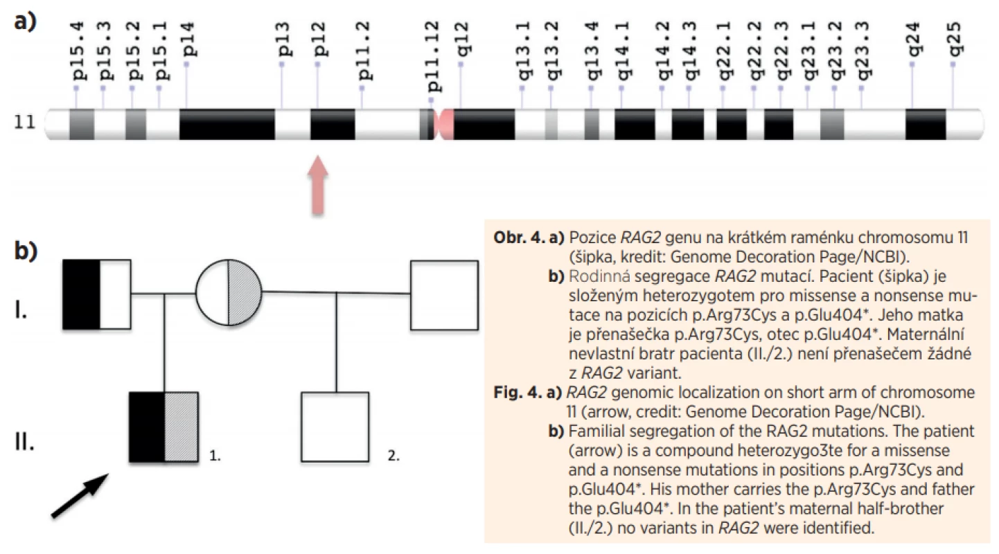 a) Pozice RAG2 genu na krátkém raménku chromosomu 11
(šipka, kredit: Genome Decoration Page/NCBI).
b) Rodinná segregace RAG2 mutací. Pacient (šipka) je
složeným heterozygotem pro missense a nonsense mutace na pozicích p.Arg73Cys a p.Glu404*. Jeho matka
je přenašečka p.Arg73Cys, otec p.Glu404*. Maternální
nevlastní bratr pacienta (II./2.) není přenašečem žádné
z RAG2 variant.<br>
Fig. 4. a) RAG2 genomic localization on short arm of chromosome
11 (arrow, credit: Genome Decoration Page/NCBI).
b) Familial segregation of the RAG2 mutations. The patient
(arrow) is a compound heterozygo3te for a missense
and a nonsense mutations in positions p.Arg73Cys and
p.Glu404*. His mother carries the p.Arg73Cys and father
the p.Glu404*. In the patient’s maternal half-brother
(II./2.) no variants in RAG2 were identified.