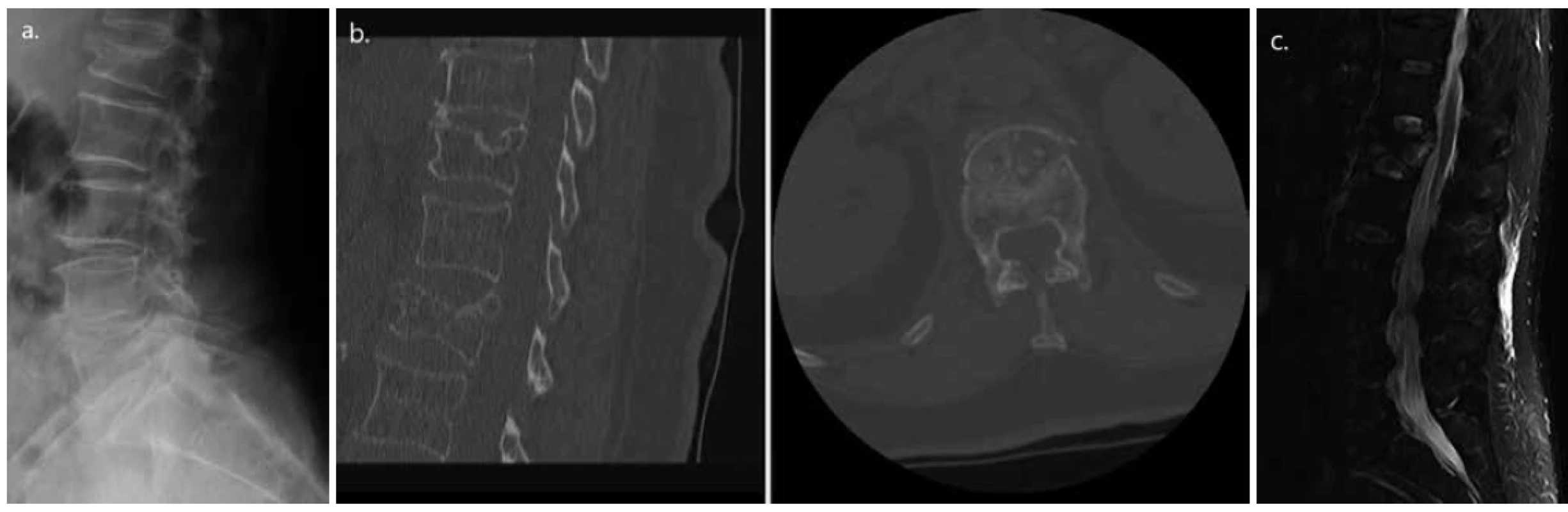 Osteoporotická komprese těla L1 charakteru kompletní tříštivé fraktury u 71leté pacientky (a. dle nativního RTG,
b. CT a c. MR)<br>
Fig. 1. Osteoporotic compression of vertebra L1, complete burst type in a 71 years old female patient (a. Native X-ray; b.
CT; and c. MRI scan)