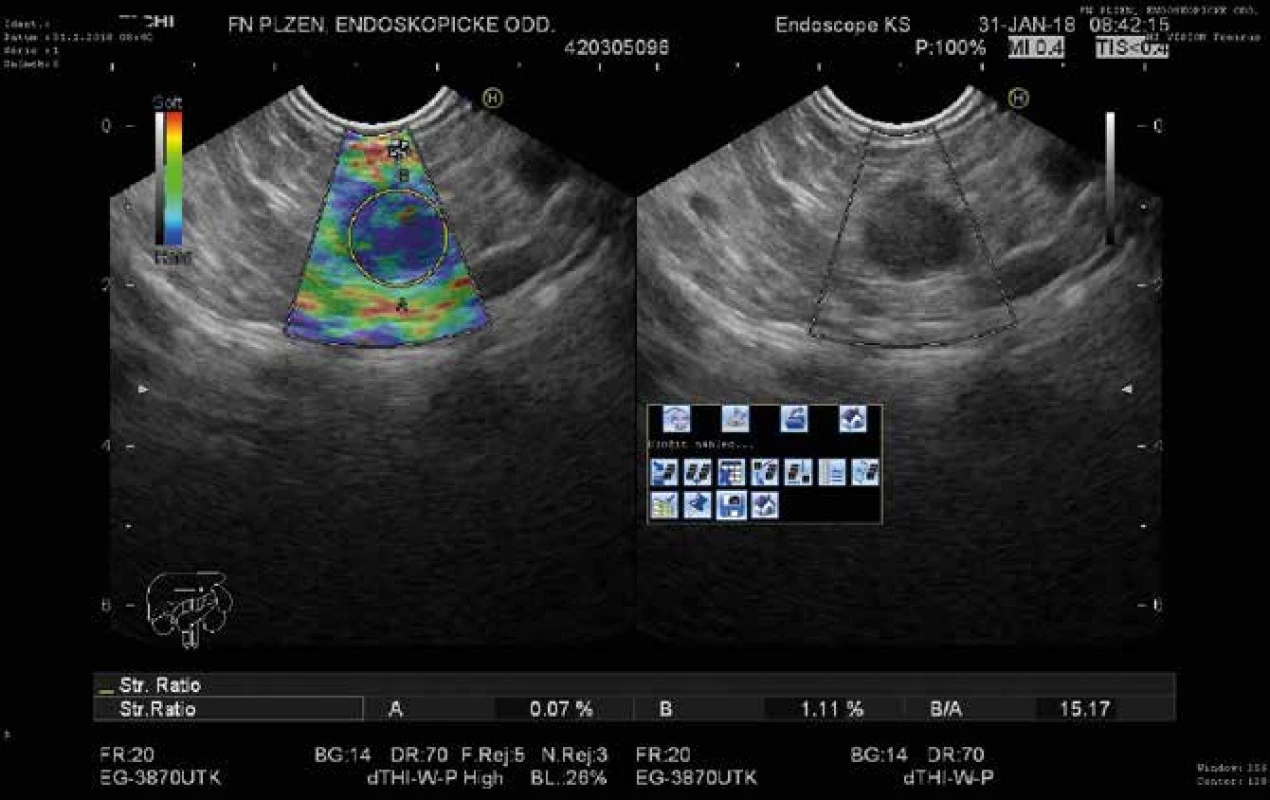 Metastáza světlobuněčného karcinomu ledviny do pankreatu v endoUSG obraze<br>
Fig. 1: EUS findings of clear cell renal carcinoma metastasis to the pancreas 