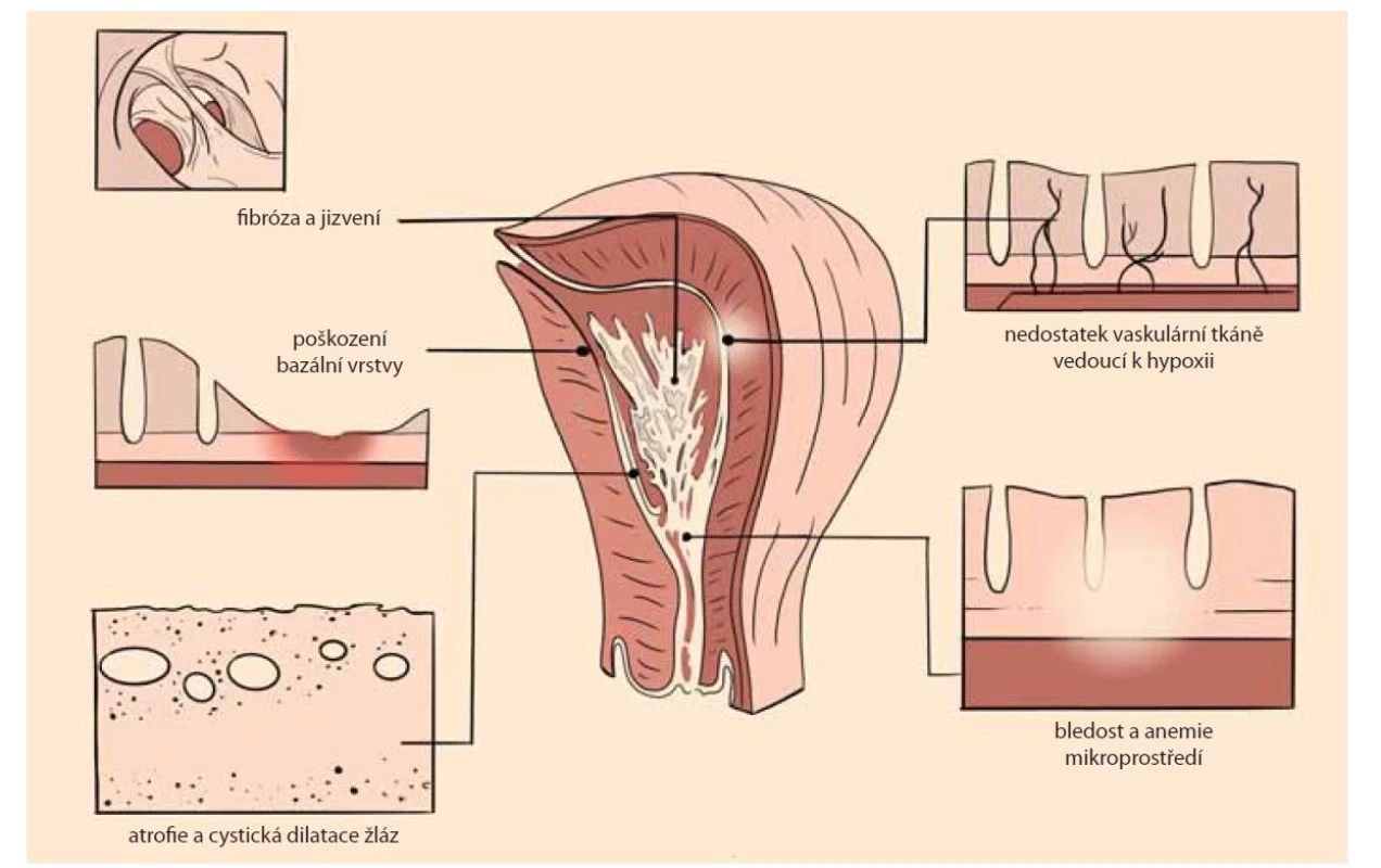 Patogeneze formace intrauterinní adheze [28].<br>
Fig. 1. Pathogenesis of intrauterine adhesion formation [28].