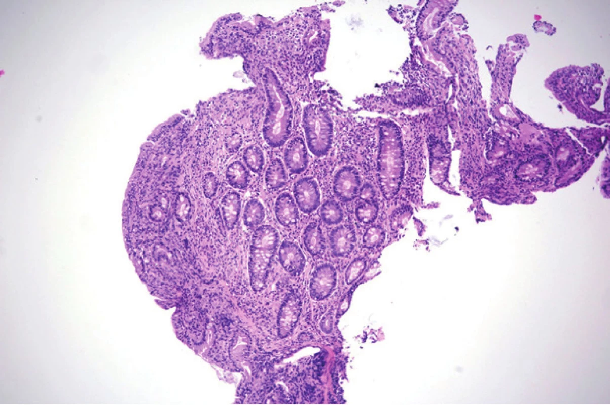 Histologický obraz duodena pacientky. Barveno hematoxylinem a
eozinem, zvětšeno 200×. Zobrazena sliznice duodena s úplnou atrofií klků,
hyperplazií krypt a chronickou zánětlivou celulizací lamina propria mucosae.
Obrázek poskytnut MUDr. M. Daumovou, Ph.D. (Šiklův ústav patologie, Fakultní
nemocnice Plzeň)