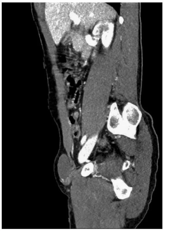 Postkontrastní CT vyšetření – sagitální zobrazení
s nálezem dislokovaného varlete<br>
Fig. 2. Initial CT scan – sagital section showing the
dislocated testis