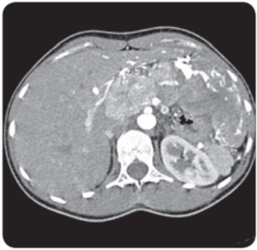  Vyšetření CT ukazuje typické chování hepatocelulárního karcinomu, hypervaskularizaci v arteriální fázi a vymývání ve fázi portální. Nález u mladé
24leté ženy charakteru typického fi brolamelárního karcinomu s postižením levého laloku a také s uzlinovými metastázami v portální skupině.