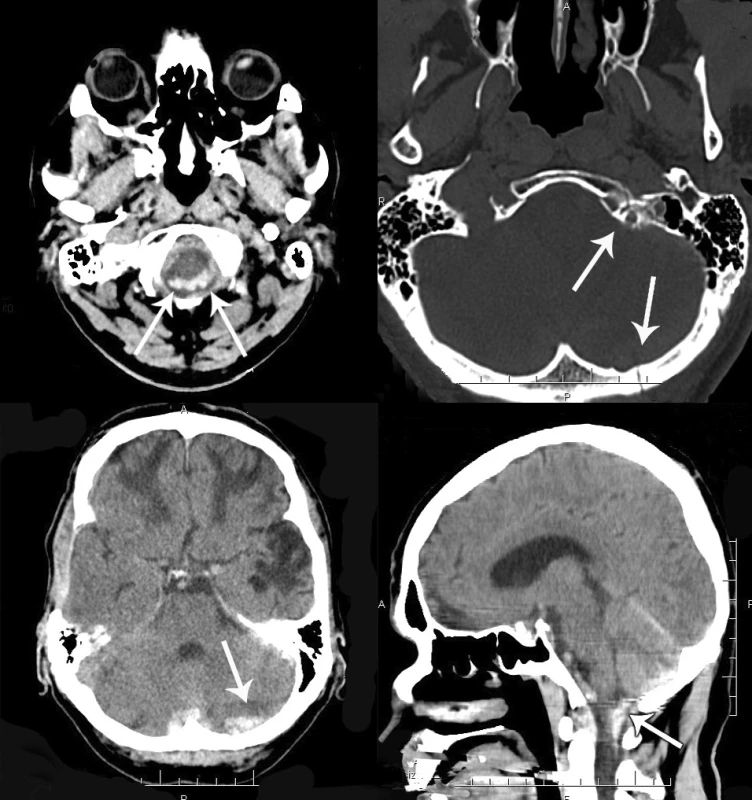 A – CT scan (transverse plane), intraspinal subdural hemorrhagic
collection around the medulla. B – occipital bone fracture and fracture of
the anterior arch of the C1 vertebra on the left side. C – CT scan (transverse
section), subdural hematoma in the left posterior fossa and subarachnoid
hemorrhage around the left cerebellar hemisphere. D – CT scan (sagittal
section), infratentorial and spinal subdural hematoma.