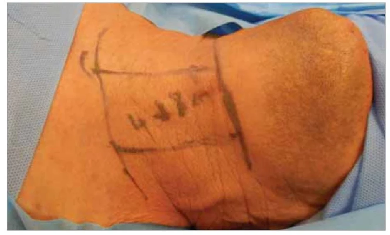 Vyznačenie kožnej incízie s dizajnom kožného ostrova infrahyoidného
laloka.<br>
Fig.3 Outline of the skin incision with the skin island design of the infrahyoid flap.