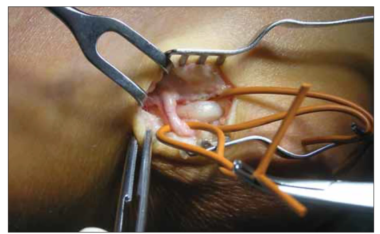 Větev nervus cutaneus antebrachii medialis přebíhající přes nervus ulnaris.<br>
Fig. 1. Branch of the medial antebrachial cutaneus nerve crossing the ulnar nerve.