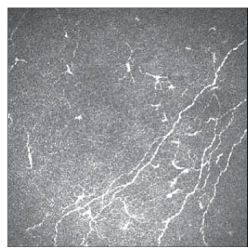 Patologické postižení tenkých vláken
s patrnou aktivitou Langerhansových
buněk 2.<br>
Fig. 6. Small fiber pathology with Langerhans
cell activity 2.