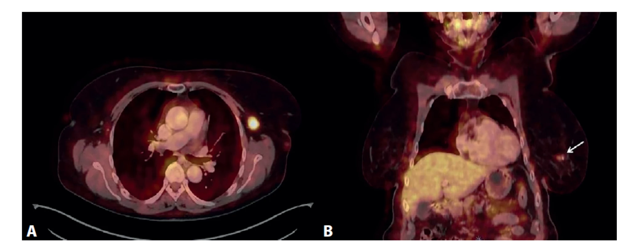 PET/CT vyšetření<br>
A) Výrazný hypermetabolizmus glukózy v jedné lymfatické uzlině levé axily, axiální zobrazení. B) Mírná akumulace FDG
v ložisku levého prsu (označeno šipkou), koronální zobrazení.<br>
Fig. 7: PET/CT examination<br>
A) Significant glucose hypermetabolism in one lymph node of the left axilla, axial view. B) Mild accumulation of FDG in
the lesion of the left breast (marked by the arrow), coronal view.