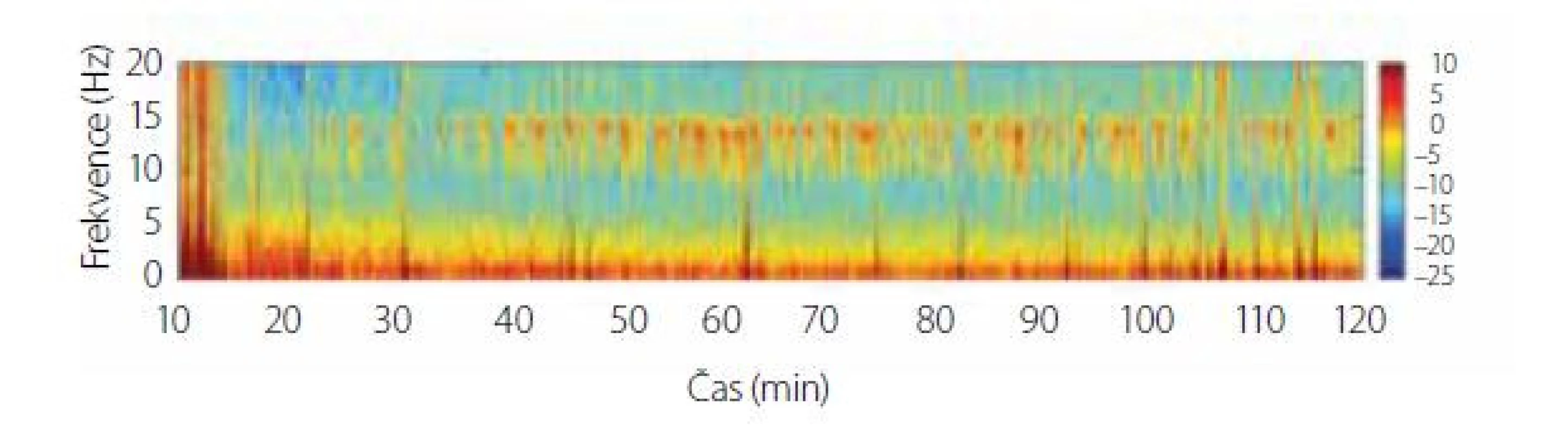Spektrogram dexmedetomidinu v sedativní dávce. Na spektrogramu
jsou patrné pomalé oscilace v pásmu SW-δ a vřetena v pásmu α/β
(9-15 Hz). Upraveno z [10]