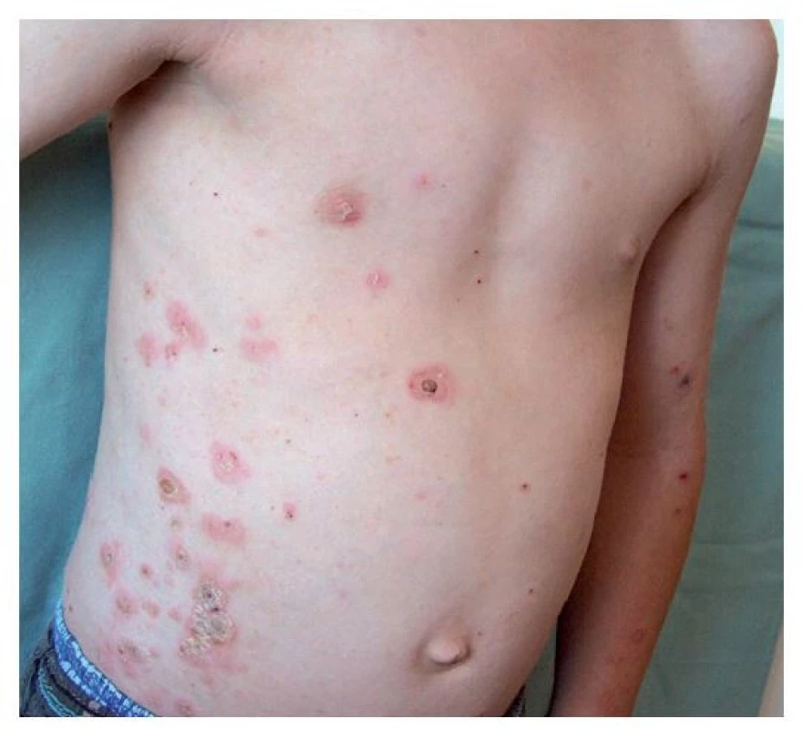 Osmiletý chlapec po návratu z letního tábora – šířící se
impetigo nevhodně ošetřené tekutým pudrem