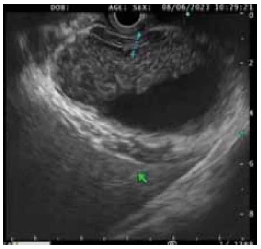 EUS zobrazení těžké, akutní
cholecystitidy. <br> 
Fig. 1. EUS imaging of severe, acute
cholecystitis.