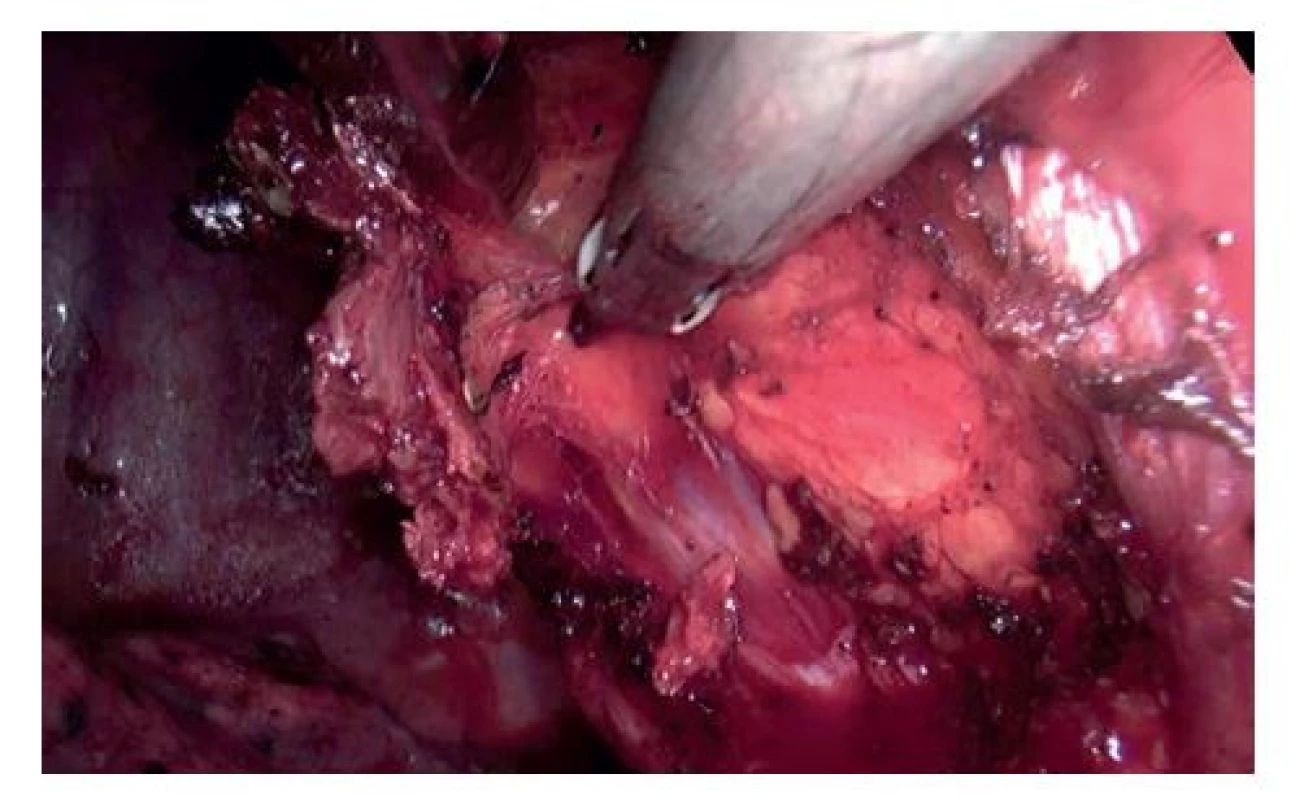 Přerušování úponu skalenického svalu harmonickým
skalpelem<br>
Fig. 4: Transection of the scalene muscle attachment
using the harmonic scalpel
