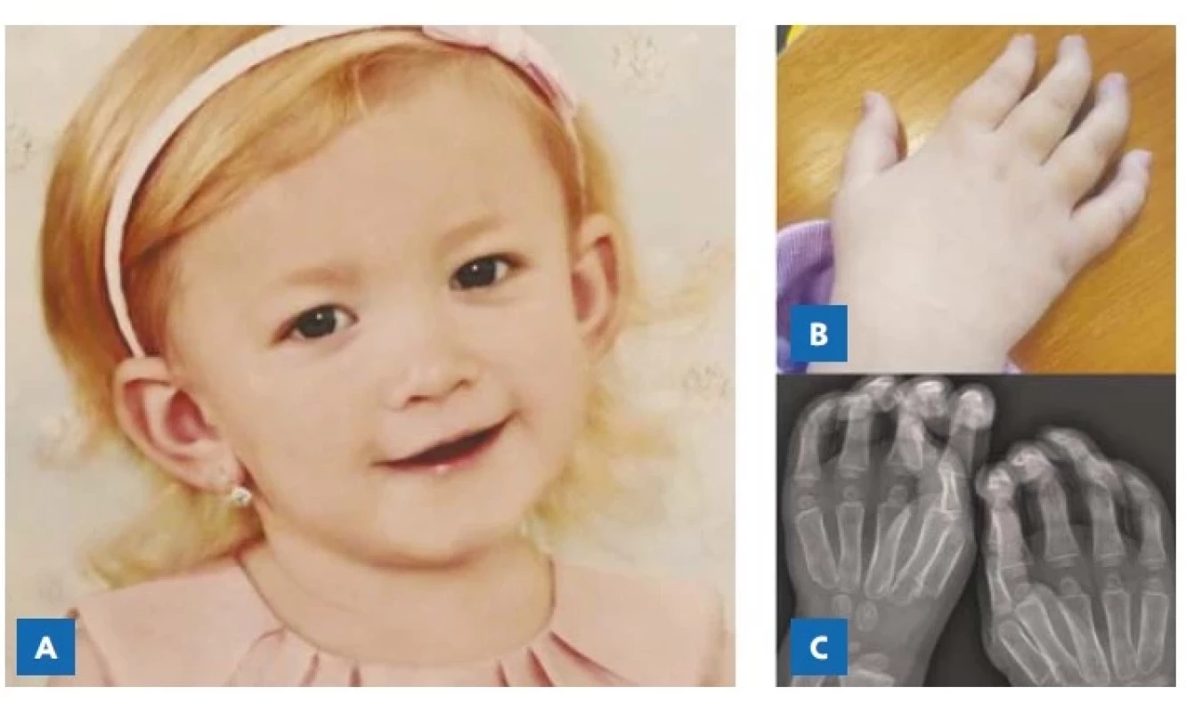 A – Dívka ve věku 4 let bez patrných projevů
kraniofaciální dysmorfie (publikováno se souhlasem zákonných
zástupců). B – Drápovitá ruka s kontrakturami
prstů, širším zápěstím a omezením jemné motoriky.
C – Rtg ruky s naznačenými masivnějšími a neforemnými
metakarpy
