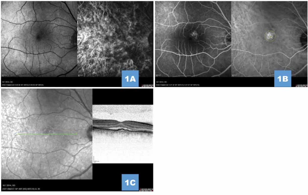 (A) Simultánní fluorescenční a indocyaninová angiografie v prearteriální a (B) pozdní venózní fázi angiogramu znázorňuje okrouhlé subfoveolární ložisko pozvolné hyperfluorescence s vyznačenou šířkou stopy pro fotodynamickou terapii (žluté ohraničení), na angiogramu nejsou známky choroidální neovaskularizace (C) Transfoveolární lineární sken prokazující undulující linii retinálního pigmentového epitelu, subretinální tekutinu a poměrně dobře zachované jednotlivé retinální vrstvy
