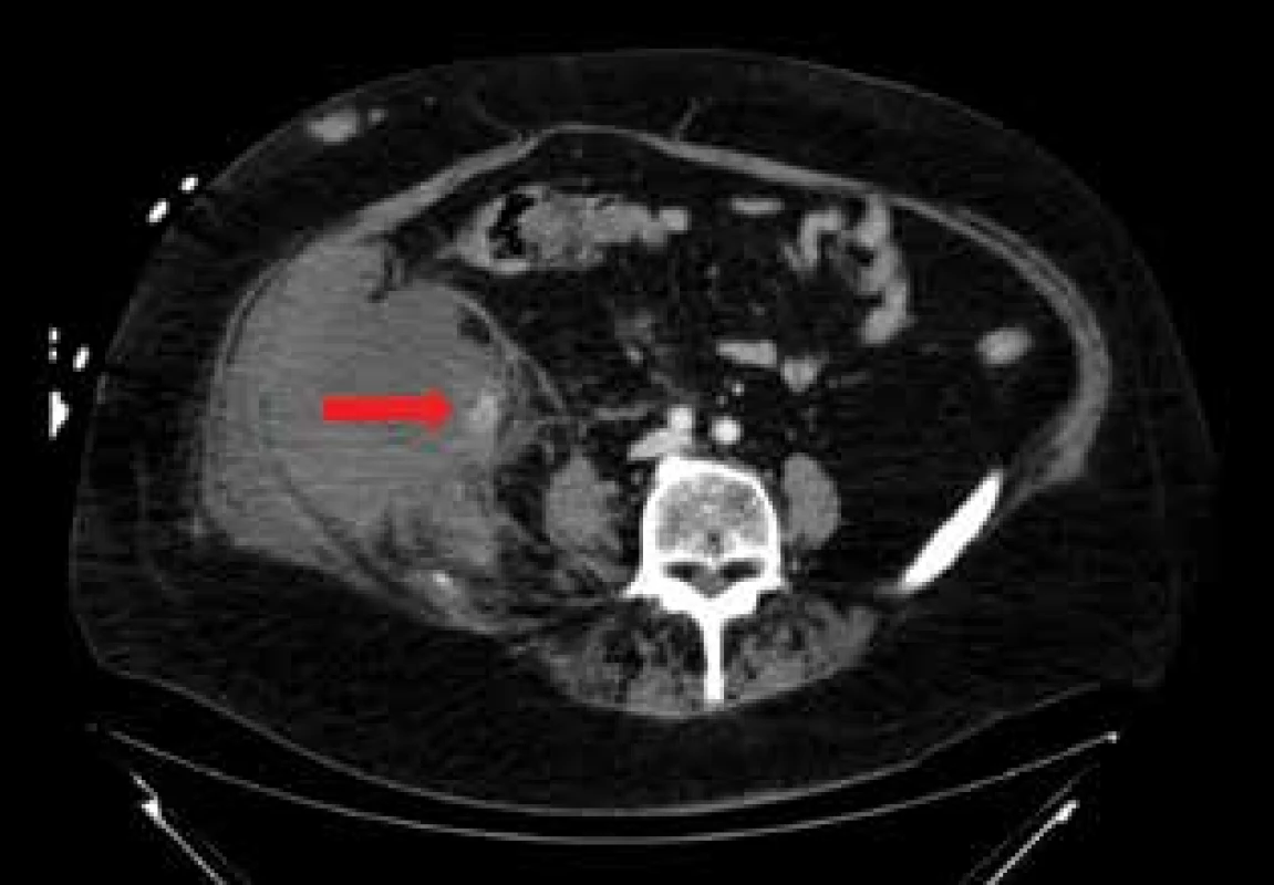 CT transverzální řez: hematom retroperitonea
vpravo s viditelným krvácením v mediokaudální porci
(označeno šipkou)<br>
Fig. 2: CT (transversal scan): hematoma of the retroperitoneum
on the right with visible bleeding in the mediocaudal
part (indicated by an arrow)