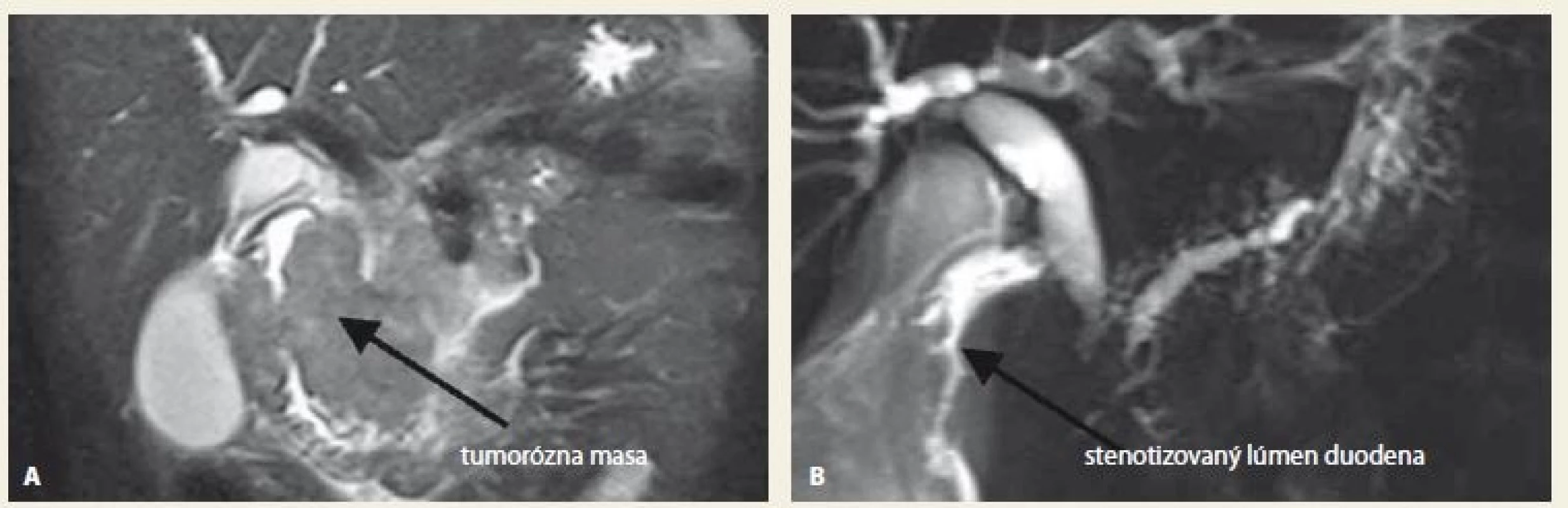 Dôležité pred endoskopickým výkonom je zhodnotiť dostupné zobrazovacie modality, MR vyšetrenie.
Zdroj: Archív Jessenius Nitra.<br>
Fig. 2. Before endoscopy, it is important to also evaluate other diagnostics modalities (magnetic resonance).
Source: Archive Jessenius Nitra.