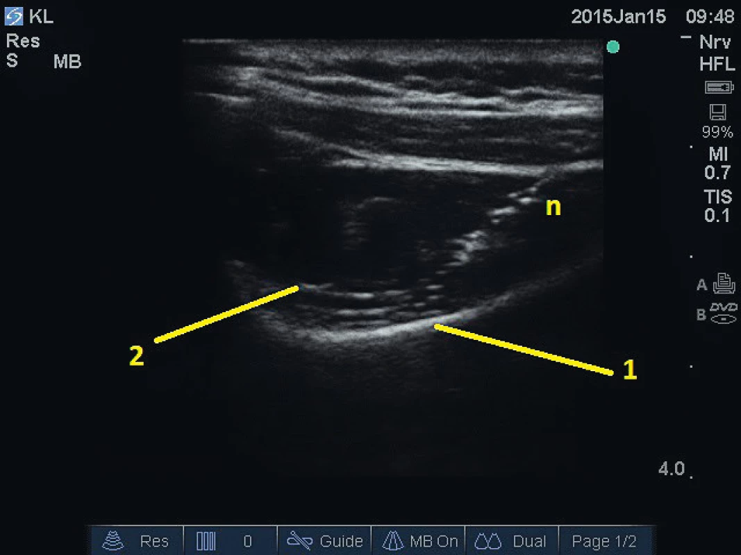 Blokáda nervus suprascapularis v zářezu lopatky.
1 – supraskapulární zářez, 2 – ligamentum suprascapulare, n –
jehla