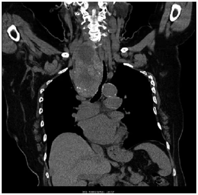 CT nález retrosternální strumy, žena 77 let <br> 
Fig. 1. CT finding of retrosternal goiter, 77-year-old woman