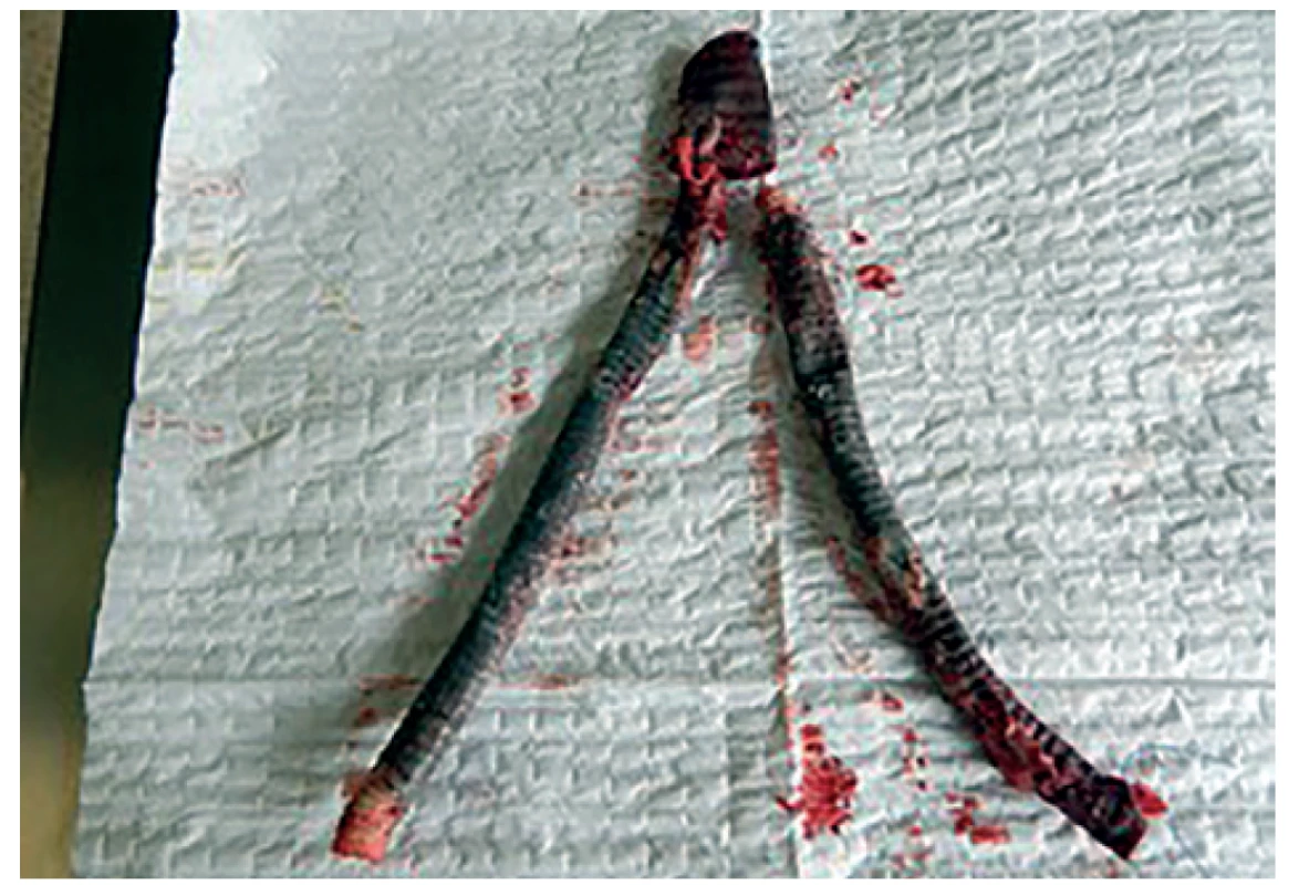 Explantovaná protéza ABF bypassu <br>
Fig. 1: Explanted infected aortobifemoral prosthesis