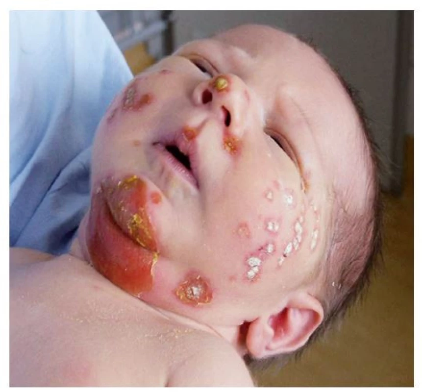 Dvoutýdenní novorozenec s bulózním impetigem – na bradě
eroze po stržení krytby puchýře