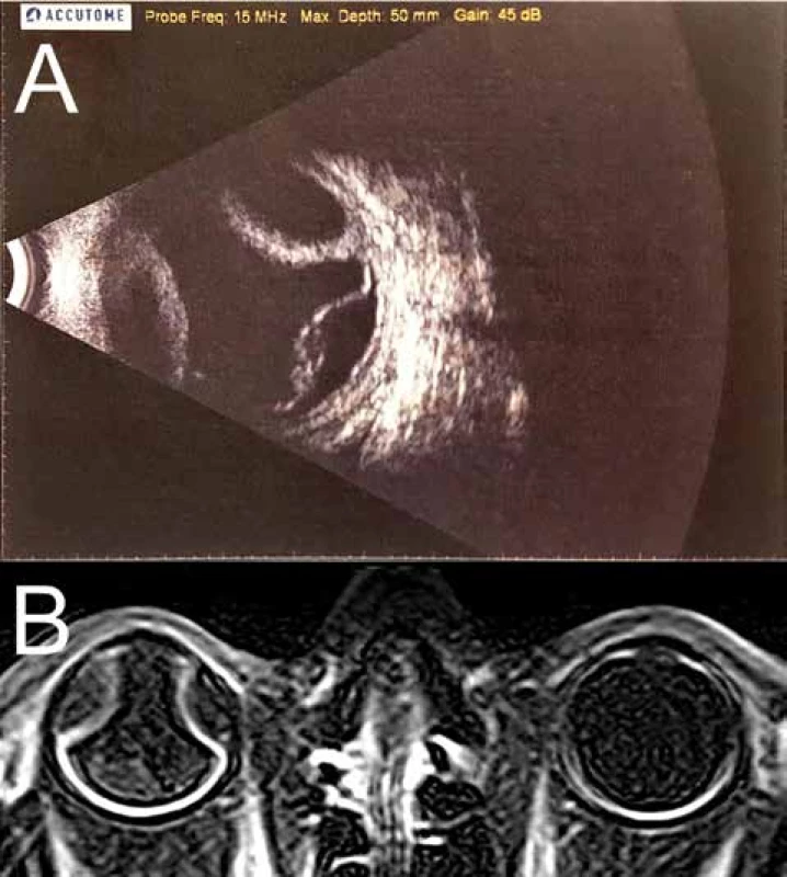 (A) Ultrazvuková sonografie bulbu pravého oka, B scan, listopad 2017. Shora ablace
choroidey, zdola serózní odchlípení sítnice. (B) magnetická rezonance orbit, T1 vážený
obraz, listopad 2017. Ablace choroidey a serózní odchlípení sítnice