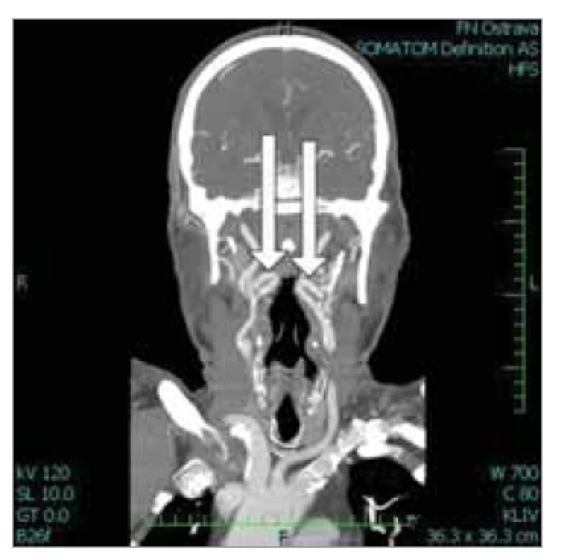 Oboustranný kinking a. carotis
interna, vzdálenost od stěny hltanu
2 mm.<br>
Fig. 4. Bilateral kinking of the internal
carotid artery, distance from the pharyngeal
wall 2 mm.