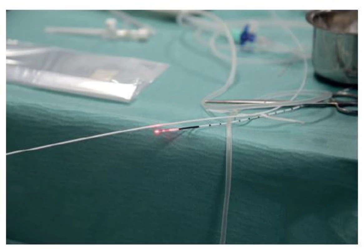 Radiálně emitující laserové vlákno (ELVeS® Radial®
2ring) připravené před operací (publikováno se souhlasem
firmy Biolitec)<br>
Fig. 6: Radially emitting laser fiber (ELVeS® Radial® 2ring)
prepared before surgery (published with permission
from Biolitec)