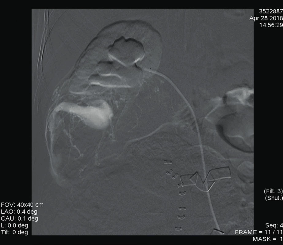 Digitální subtrakční angiografie a. renalis dextra: zobrazuje
se patologická vaskularizace angiomyolipomu s AV zkratem
s ektatickou odvodnou žilou [6]