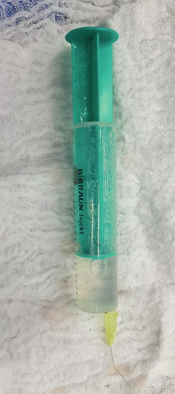 Solution for intraluminary irrigation during microvascular suture used at our department. Solution is consisting of: 10ml of Mesocain 1%, 10ml MgSO4 10%, 5ml of Agapurin (Pentoxifyllinum 100 mg). Then 19ml of this solution is mixed with 1ml of Heparin 5000 IU/ml (archive of the author)