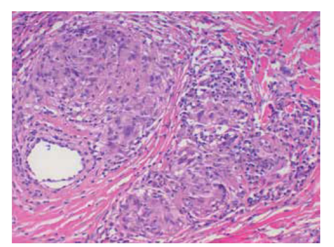 Sarkoidální granulomy u necrobiosis lipoidica
(HE 200x)