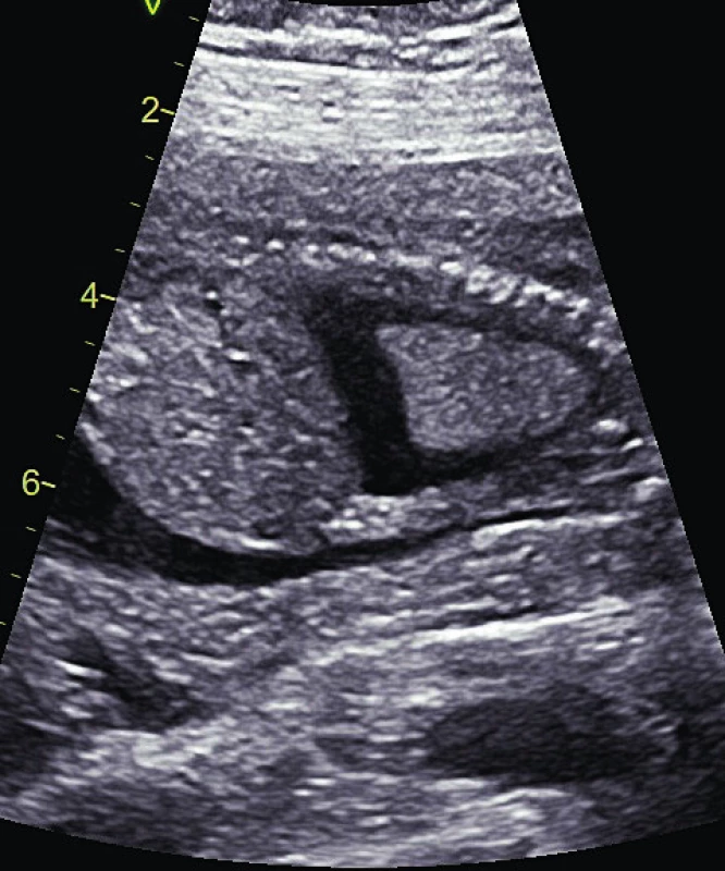 Fetální pleurální výpotek.<br>
Fig. 3. Fetal pleural effusion.