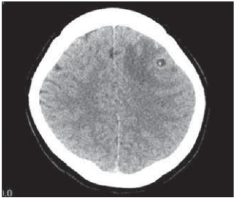 CT scan of the brain, transversal
image. Round-shaped hypodense lesion
in the left frontal region, sized 7 mm, with
central dot-like hyperdensity; the lesion
corresponds to neurocysticercosis. <br>
Obr. 1. CT mozku, transverzální řez. Kulovité hypodenzní ložisko frontálně vlevo
velikosti 7 mm, s centrální tečkovitou hyperdenzitou odpovídá neurocysticerkóze.