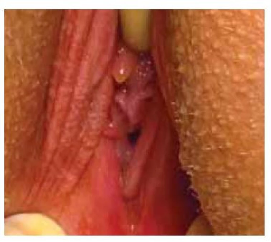 Vzhled vaginálního introitu
u pacientky s transverzálním vaginálním
septem – za hymenem prostupná
distální část pochvy.<br>
Fig. 4. Appearance of the vaginal introitus
in a patient with a transverse vaginal
septum – the distal part of the vagina
permeable behind the hymen.